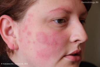 http://www.dermatology.ru/files/imagecache/case/files/cases/12131/2_099.jpg